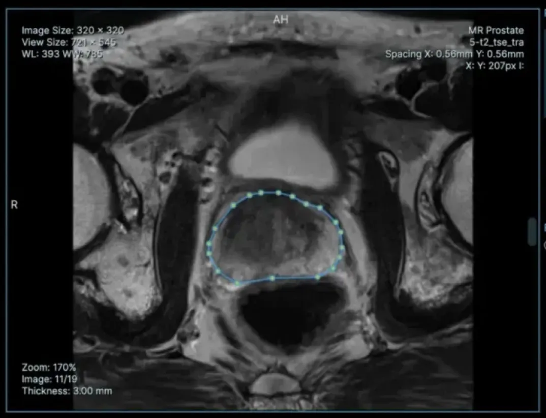 An MRI scan, with the area to check outlined.