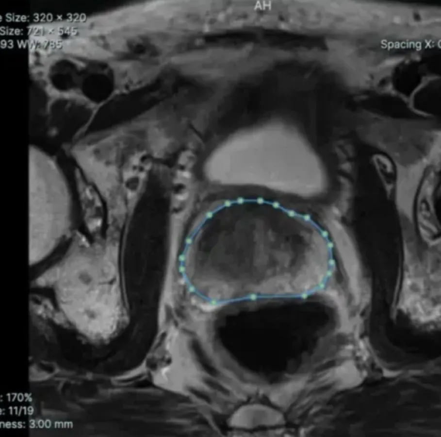 An MRI scan, with the area to check outlined.